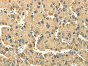 The image on the left is immunohistochemistry of paraffin-embedded Human liver cancer tissue using CSB-PA159160(TULP2 Antibody) at dilution 1/30, on the right is treated with fusion protein. (Original magnification: ×200)