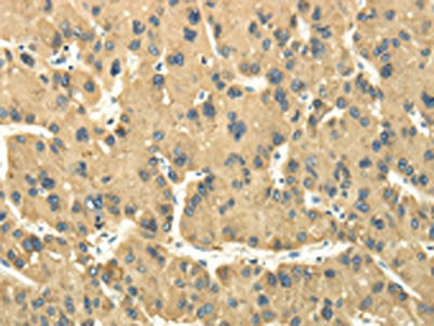 The image on the left is immunohistochemistry of paraffin-embedded Human liver cancer tissue using CSB-PA159160(TULP2 Antibody) at dilution 1/30, on the right is treated with fusion protein. (Original magnification: ×200)