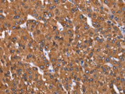 The image on the left is immunohistochemistry of paraffin-embedded Human liver cancer tissue using CSB-PA159201(HRASLS2 Antibody) at dilution 1/40, on the right is treated with synthetic peptide. (Original magnification: ×200)