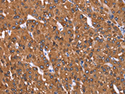 The image on the left is immunohistochemistry of paraffin-embedded Human liver cancer tissue using CSB-PA159201(HRASLS2 Antibody) at dilution 1/40, on the right is treated with synthetic peptide. (Original magnification: ×200)