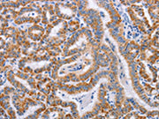 The image on the left is immunohistochemistry of paraffin-embedded Human thyroid cancer tissue using CSB-PA159485(BST1 Antibody) at dilution 1/50, on the right is treated with synthetic peptide. (Original magnification: ×200)
