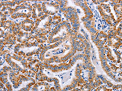 The image on the left is immunohistochemistry of paraffin-embedded Human thyroid cancer tissue using CSB-PA159485(BST1 Antibody) at dilution 1/50, on the right is treated with synthetic peptide. (Original magnification: ×200)