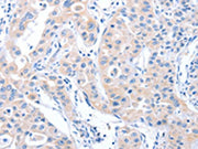 The image on the left is immunohistochemistry of paraffin-embedded Human lung cancer tissue using CSB-PA159616(ARHGEF6 Antibody) at dilution 1/70, on the right is treated with synthetic peptide. (Original magnification: ×200)