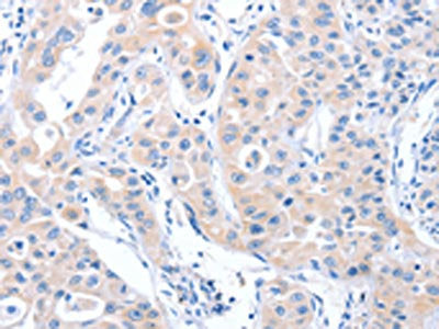 The image on the left is immunohistochemistry of paraffin-embedded Human lung cancer tissue using CSB-PA159616(ARHGEF6 Antibody) at dilution 1/70, on the right is treated with synthetic peptide. (Original magnification: ×200)