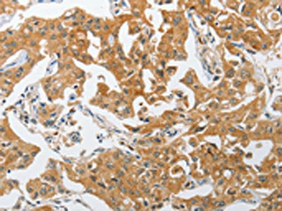 The image on the left is immunohistochemistry of paraffin-embedded Human lung cancer tissue using CSB-PA159945(PIK3R3 Antibody) at dilution 1/25, on the right is treated with synthetic peptide. (Original magnification: ×200)