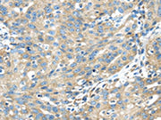 The image on the left is immunohistochemistry of paraffin-embedded Human breast cancer tissue using CSB-PA160058(TXNDC5 Antibody) at dilution 1/40, on the right is treated with fusion protein. (Original magnification: ×200)