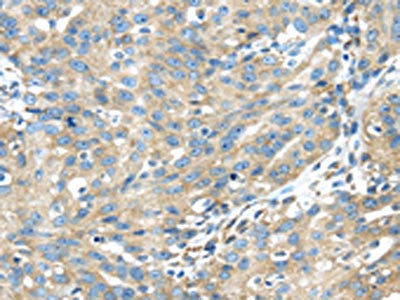The image on the left is immunohistochemistry of paraffin-embedded Human breast cancer tissue using CSB-PA160058(TXNDC5 Antibody) at dilution 1/40, on the right is treated with fusion protein. (Original magnification: ×200)