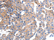 The image on the left is immunohistochemistry of paraffin-embedded Human breast cancer tissue using CSB-PA160122(GCG Antibody) at dilution 1/15, on the right is treated with synthetic peptide. (Original magnification: ×200)