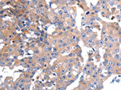 The image on the left is immunohistochemistry of paraffin-embedded Human breast cancer tissue using CSB-PA160122(GCG Antibody) at dilution 1/15, on the right is treated with synthetic peptide. (Original magnification: ×200)