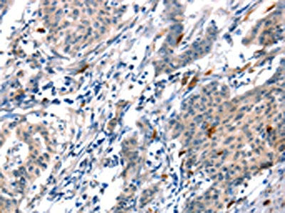 The image on the left is immunohistochemistry of paraffin-embedded Human gastic cancer tissue using CSB-PA160137(ADM Antibody) at dilution 1/20, on the right is treated with synthetic peptide. (Original magnification: ×200)