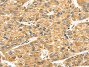 The image on the left is immunohistochemistry of paraffin-embedded Human liver cancer tissue using CSB-PA160205(SH3KBP1 Antibody) at dilution 1/40, on the right is treated with fusion protein. (Original magnification: ×200)