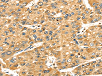 The image on the left is immunohistochemistry of paraffin-embedded Human liver cancer tissue using CSB-PA160205(SH3KBP1 Antibody) at dilution 1/40, on the right is treated with fusion protein. (Original magnification: ×200)