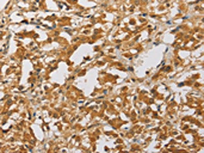 The image on the left is immunohistochemistry of paraffin-embedded Human thyroid cancer tissue using CSB-PA160272(ARHGEF5 Antibody) at dilution 1/40, on the right is treated with fusion protein. (Original magnification: ×200)
