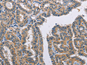 The image on the left is immunohistochemistry of paraffin-embedded Human thyroid cancer tissue using CSB-PA160291(TLR8 Antibody) at dilution 1/35, on the right is treated with fusion protein. (Original magnification: X200)