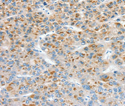 Immunohistochemical analysis of paraffin-embedded Human liver cancer tissue using at dilution 1/30.