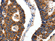 The image on the left is immunohistochemistry of paraffin-embedded Human colon cancer tissue using CSB-PA160596(ITGB6 Antibody) at dilution 1/10, on the right is treated with fusion protein. (Original magnification: ×200)