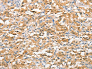 The image on the left is immunohistochemistry of paraffin-embedded Human thyroid cancer tissue using CSB-PA160666(UBQLN1 Antibody) at dilution 1/15, on the right is treated with fusion protein. (Original magnification: ×200)