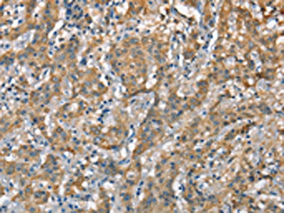 The image on the left is immunohistochemistry of paraffin-embedded Human gastic cancer tissue using CSB-PA160733(CSMD1 Antibody) at dilution 1/40, on the right is treated with synthetic peptide. (Original magnification: ×200)