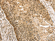 The image on the left is immunohistochemistry of paraffin-embedded Human esophagus cancer tissue using CSB-PA160836(STAG2 Antibody) at dilution 1/35, on the right is treated with fusion protein. (Original magnification: ×200)