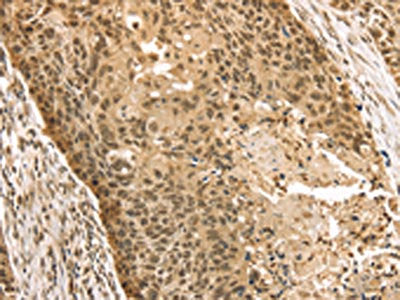 The image on the left is immunohistochemistry of paraffin-embedded Human esophagus cancer tissue using CSB-PA160836(STAG2 Antibody) at dilution 1/35, on the right is treated with fusion protein. (Original magnification: ×200)