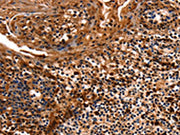 The image on the left is immunohistochemistry of paraffin-embedded Human tonsil tissue using CSB-PA160863(HSPD1 Antibody) at dilution 1/12, on the right is treated with fusion protein. (Original magnification: ×200)