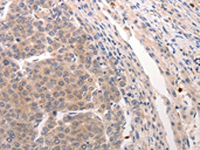 The image on the left is immunohistochemistry of paraffin-embedded Human breast cancer tissue using CSB-PA160889(CDC37 Antibody) at dilution 1/20, on the right is treated with synthetic peptide. (Original magnification: ×200)