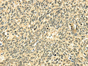 The image on the left is immunohistochemistry of paraffin-embedded Human lung cancer tissue using CSB-PA160915(ECE2 Antibody) at dilution 1/20, on the right is treated with fusion protein. (Original magnification: ×200)