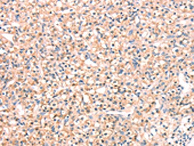 The image on the left is immunohistochemistry of paraffin-embedded Human prostate cancer tissue using CSB-PA161006(SNAP23 Antibody) at dilution 1/25, on the right is treated with fusion protein. (Original magnification: ×200)