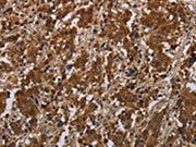 The image on the left is immunohistochemistry of paraffin-embedded Human liver cancer tissue using CSB-PA161181(FGF20 Antibody) at dilution 1/20, on the right is treated with synthetic peptide. (Original magnification: ×200)