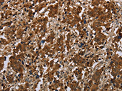 The image on the left is immunohistochemistry of paraffin-embedded Human liver cancer tissue using CSB-PA161181(FGF20 Antibody) at dilution 1/20, on the right is treated with synthetic peptide. (Original magnification: ×200)