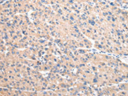 The image on the left is immunohistochemistry of paraffin-embedded Human liver cancer tissue using CSB-PA161202(VAMP4 Antibody) at dilution 1/30, on the right is treated with fusion protein. (Original magnification: ×200)