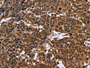 The image on the left is immunohistochemistry of paraffin-embedded Human cervical cancer tissue using CSB-PA161267(EDN2 Antibody) at dilution 1/30, on the right is treated with fusion protein. (Original magnification: ×200)