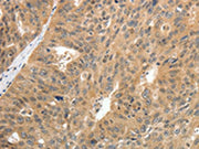 The image on the left is immunohistochemistry of paraffin-embedded Human ovarian cancer tissue using CSB-PA161346(CNNM3 Antibody) at dilution 1/25, on the right is treated with fusion protein. (Original magnification: ×200)