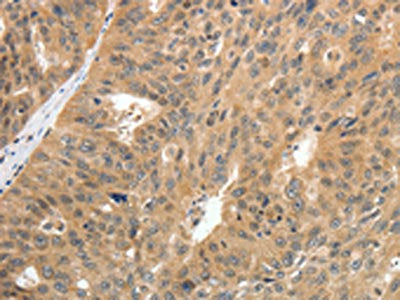 The image on the left is immunohistochemistry of paraffin-embedded Human ovarian cancer tissue using CSB-PA161346(CNNM3 Antibody) at dilution 1/25, on the right is treated with fusion protein. (Original magnification: ×200)