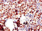 Immunohistochemistry of paraffin-embedded human lung cancer using CSB-PA16139A0Rb at dilution of 1:100