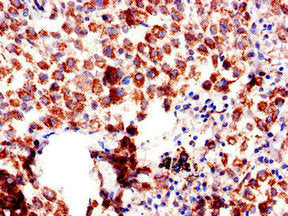 Immunohistochemistry of paraffin-embedded human lung cancer using CSB-PA16139A0Rb at dilution of 1:100