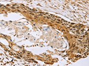 The image on the left is immunohistochemistry of paraffin-embedded Human esophagus cancer tissue using CSB-PA161569(MED12 Antibody) at dilution 1/20, on the right is treated with synthetic peptide. (Original magnification: ×200)