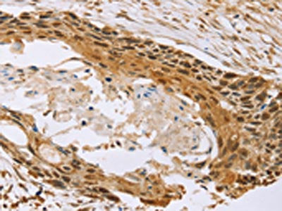 The image on the left is immunohistochemistry of paraffin-embedded Human esophagus cancer tissue using CSB-PA161569(MED12 Antibody) at dilution 1/20, on the right is treated with synthetic peptide. (Original magnification: ×200)