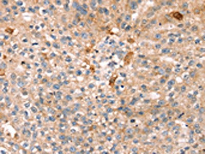 The image on the left is immunohistochemistry of paraffin-embedded Human breast cancer tissue using CSB-PA161763(THAP9 Antibody) at dilution 1/20, on the right is treated with synthetic peptide. (Original magnification: ×200)