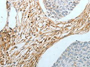 The image on the left is immunohistochemistry of paraffin-embedded Human cervical cancer tissue using CSB-PA161781(CRMP1 Antibody) at dilution 1/20, on the right is treated with fusion protein. (Original magnification: ×200)