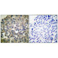 Immunohistochemical analysis of paraffin-embedded human breast carcinoma tissue using PLCG1 (Ab-771) antibody.