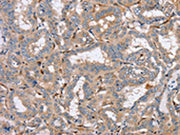 The image on the left is immunohistochemistry of paraffin-embedded Human thyroid cancer tissue using CSB-PA161857(PPM1F Antibody) at dilution 1/40, on the right is treated with synthetic peptide. (Original magnification: ×200)