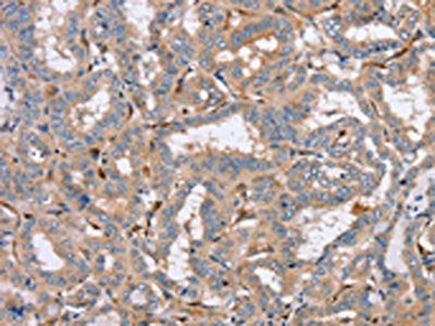 The image on the left is immunohistochemistry of paraffin-embedded Human thyroid cancer tissue using CSB-PA161857(PPM1F Antibody) at dilution 1/40, on the right is treated with synthetic peptide. (Original magnification: ×200)
