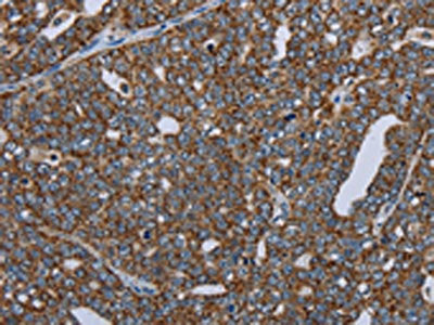 The image on the left is immunohistochemistry of paraffin-embedded Human ovarian cancer tissue using CSB-PA161916(NDUFA13 Antibody) at dilution 1/50, on the right is treated with fusion protein. (Original magnification: ×200)