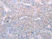 The image on the left is immunohistochemistry of paraffin-embedded Human liver cancer tissue using CSB-PA161929(SPATA6 Antibody) at dilution 1/50, on the right is treated with fusion protein. (Original magnification: ×200)