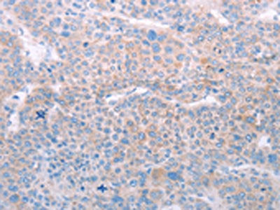 The image on the left is immunohistochemistry of paraffin-embedded Human liver cancer tissue using CSB-PA161929(SPATA6 Antibody) at dilution 1/50, on the right is treated with fusion protein. (Original magnification: ×200)