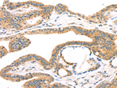 The image on the left is immunohistochemistry of paraffin-embedded Human thyroid cancer tissue using CSB-PA161937(TPH2 Antibody) at dilution 1/25, on the right is treated with synthetic peptide. (Original magnification: ×200)