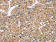 The image on the left is immunohistochemistry of paraffin-embedded Human liver cancer tissue using CSB-PA162126(TRIM34 Antibody) at dilution 1/35, on the right is treated with synthetic peptide. (Original magnification: ×200)