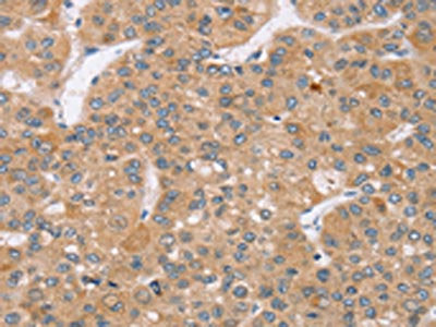 The image on the left is immunohistochemistry of paraffin-embedded Human liver cancer tissue using CSB-PA162126(TRIM34 Antibody) at dilution 1/35, on the right is treated with synthetic peptide. (Original magnification: ×200)