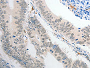The image on the left is immunohistochemistry of paraffin-embedded Human colon cancer tissue using CSB-PA162244(POU2F1 Antibody) at dilution 1/30, on the right is treated with fusion protein. (Original magnification: ×200)